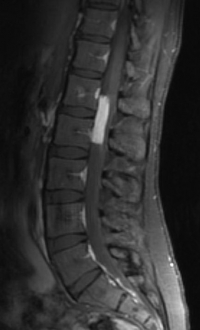 Spinal Tumor