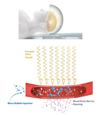 Opening the blood-brain barrier using focused ultrasoun