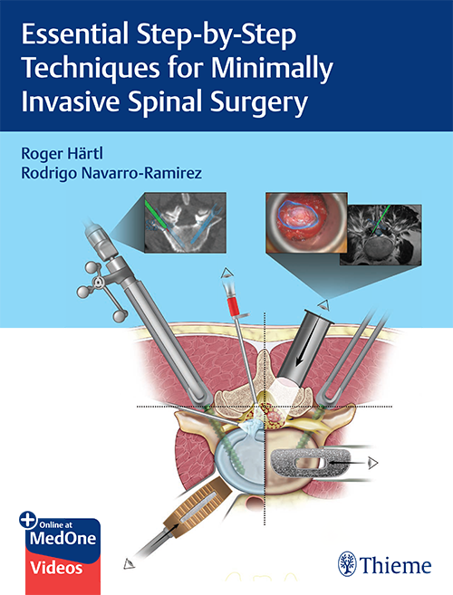 Essential Step-by-Step Techniques for Minimally Invasive Spinal Surgery