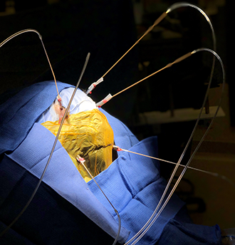 ROSA neurosurgical robot being used in a clinical trial, Weill Cornell Medicine 2019