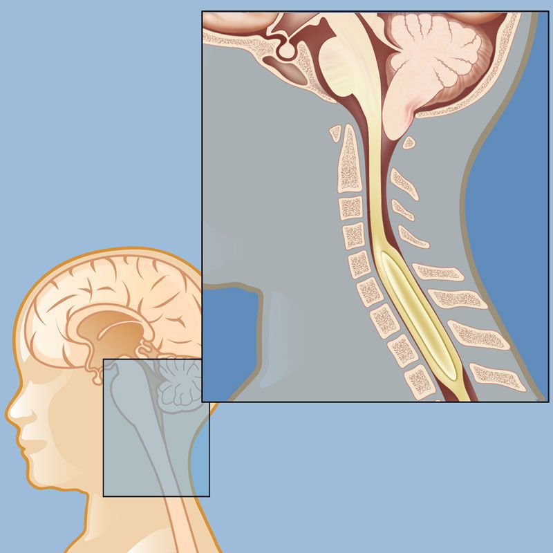 Chiari