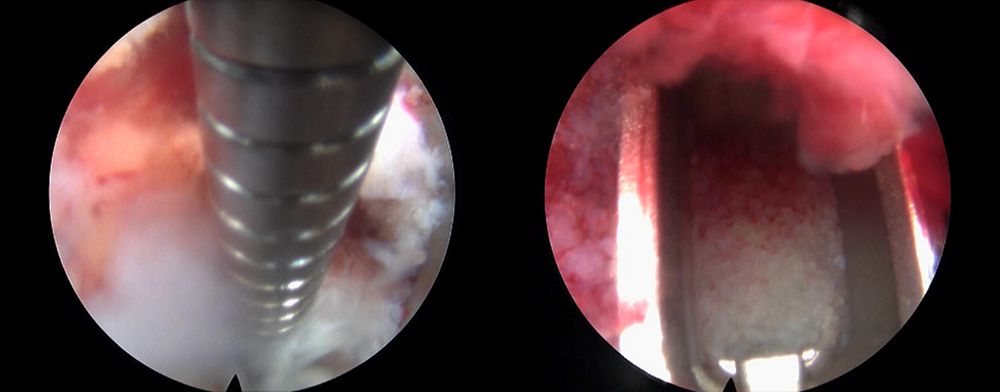 Endoscopic TLIF