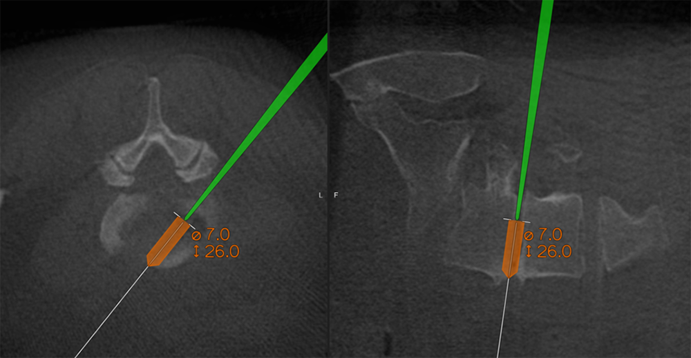 Dr. Hussain Performs First 3D-Navigation-Guided Endoscopic Lumbar Fusion in New York City