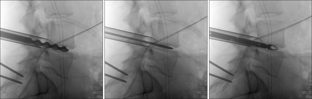 Devices used for the laminectomy and prep for cage placement