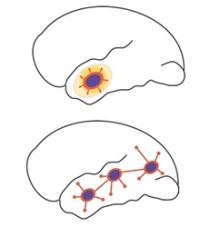 Epileptic Seizure Propogation